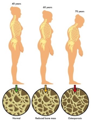 Osteoporosis Treatments