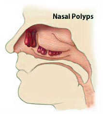 Home Remedies for Nasal Polyps