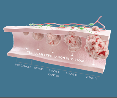 When It Comes to Colon Cancer Screening, Stop the Excuses