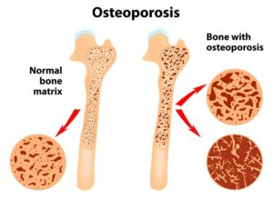 Osteoporosis