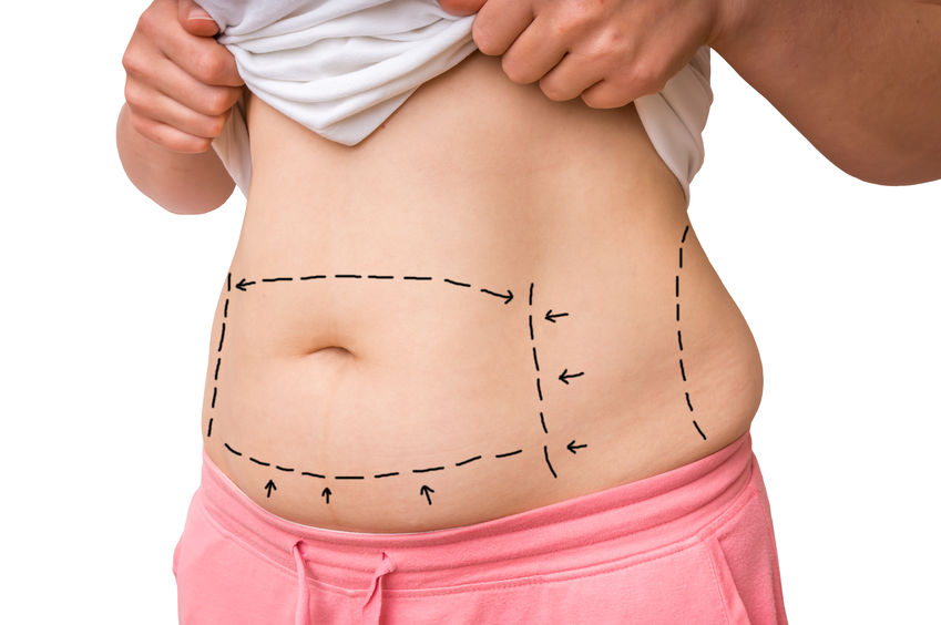 How To Manage Scars After A Tummy Tuck Surgery LivingBetter50