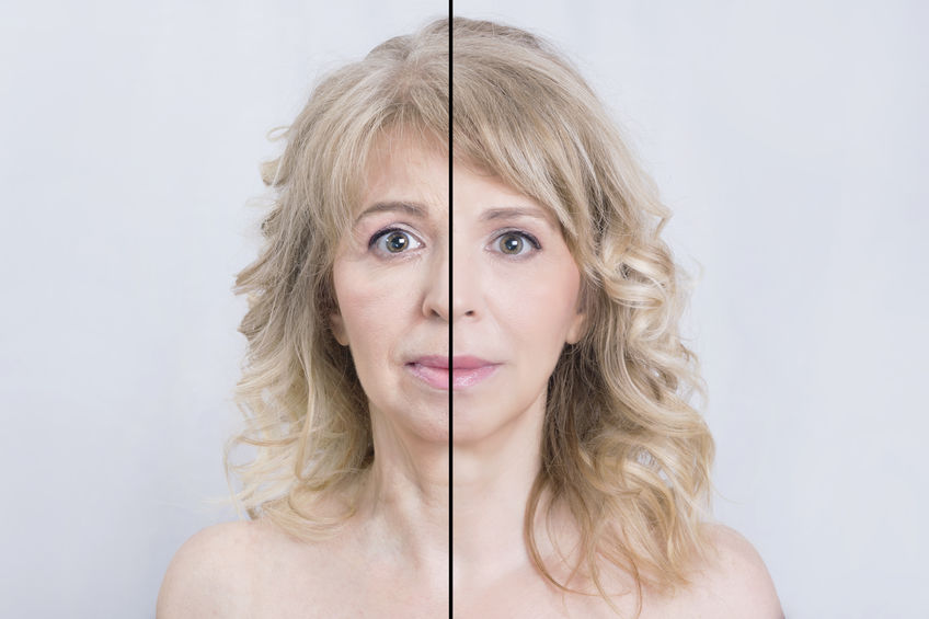 Dermal fillers